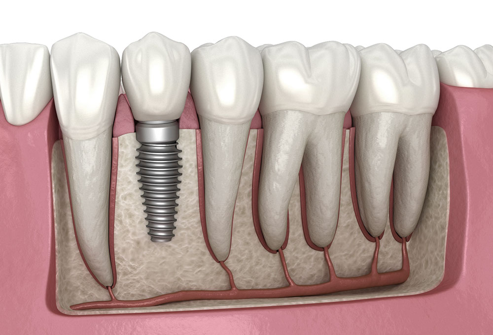 Cross-section illustration of a single dental implant set in the jawbone beside natural teeth
