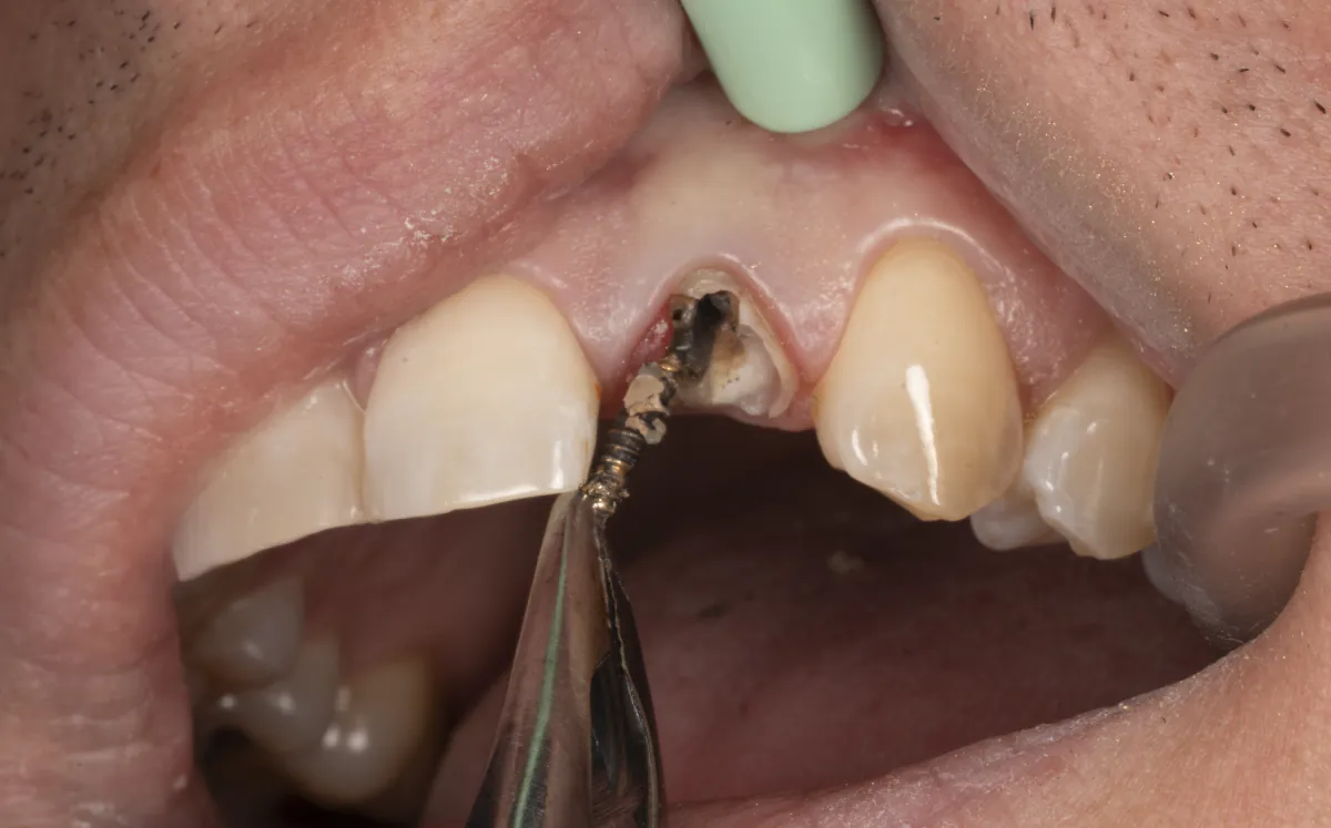 Fractured front tooth with a failing post, being removed