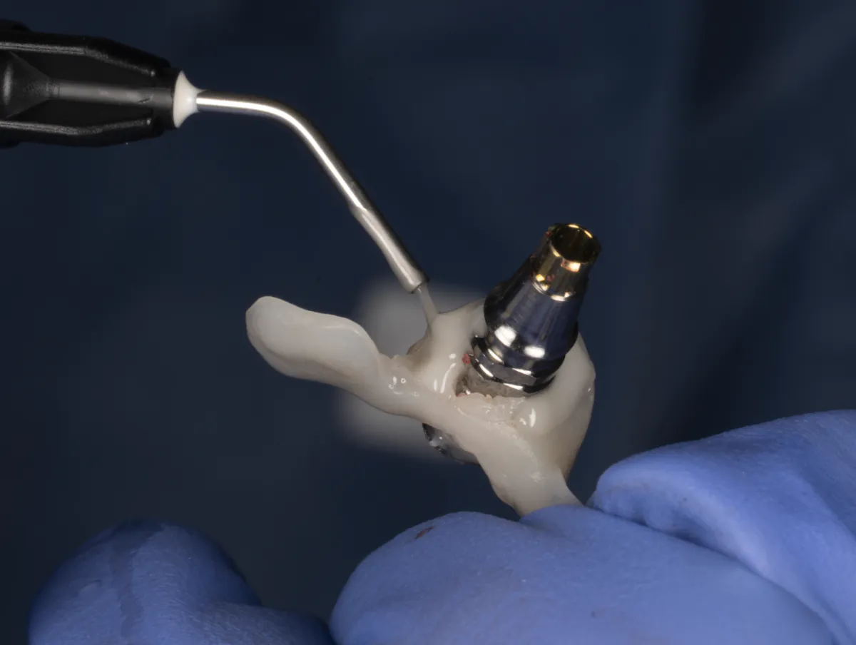 Chairside fabrication of the provisional crown on the implant abutment