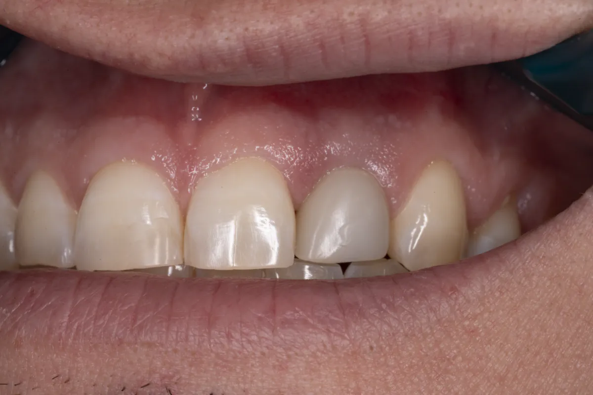Final implant crown in place with a natural gumline