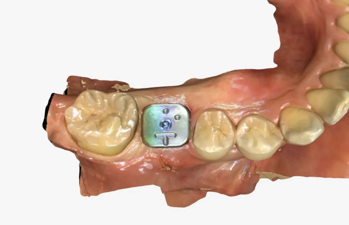 Digital scan showing the scan healing abutment in place after implant placement