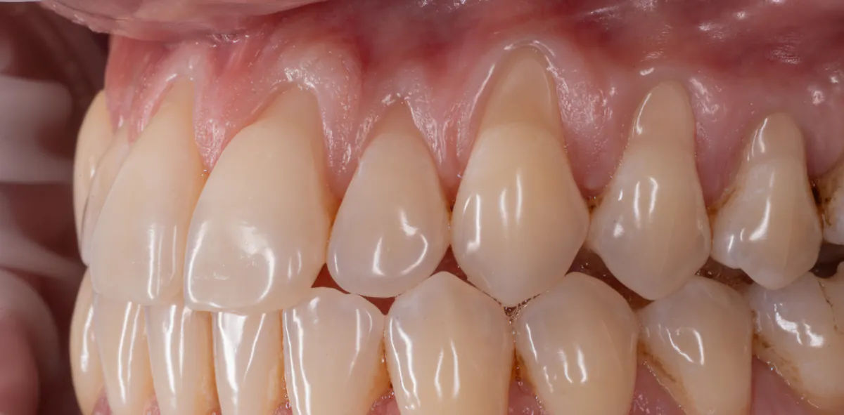 Left side before grafting, with recession and thin gum tissue