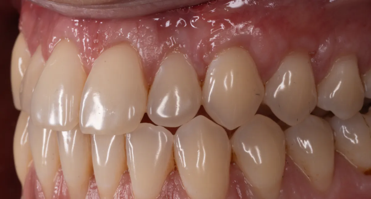 Left side after grafting, with thicker firm tissue covering the roots