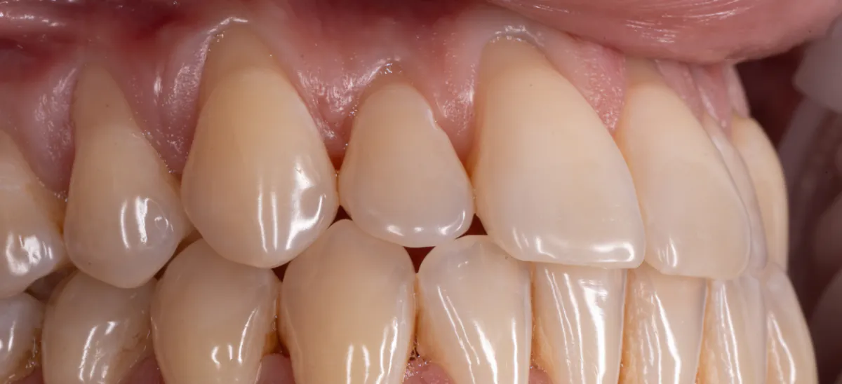 Right side before grafting, with receded gums and exposed root surfaces