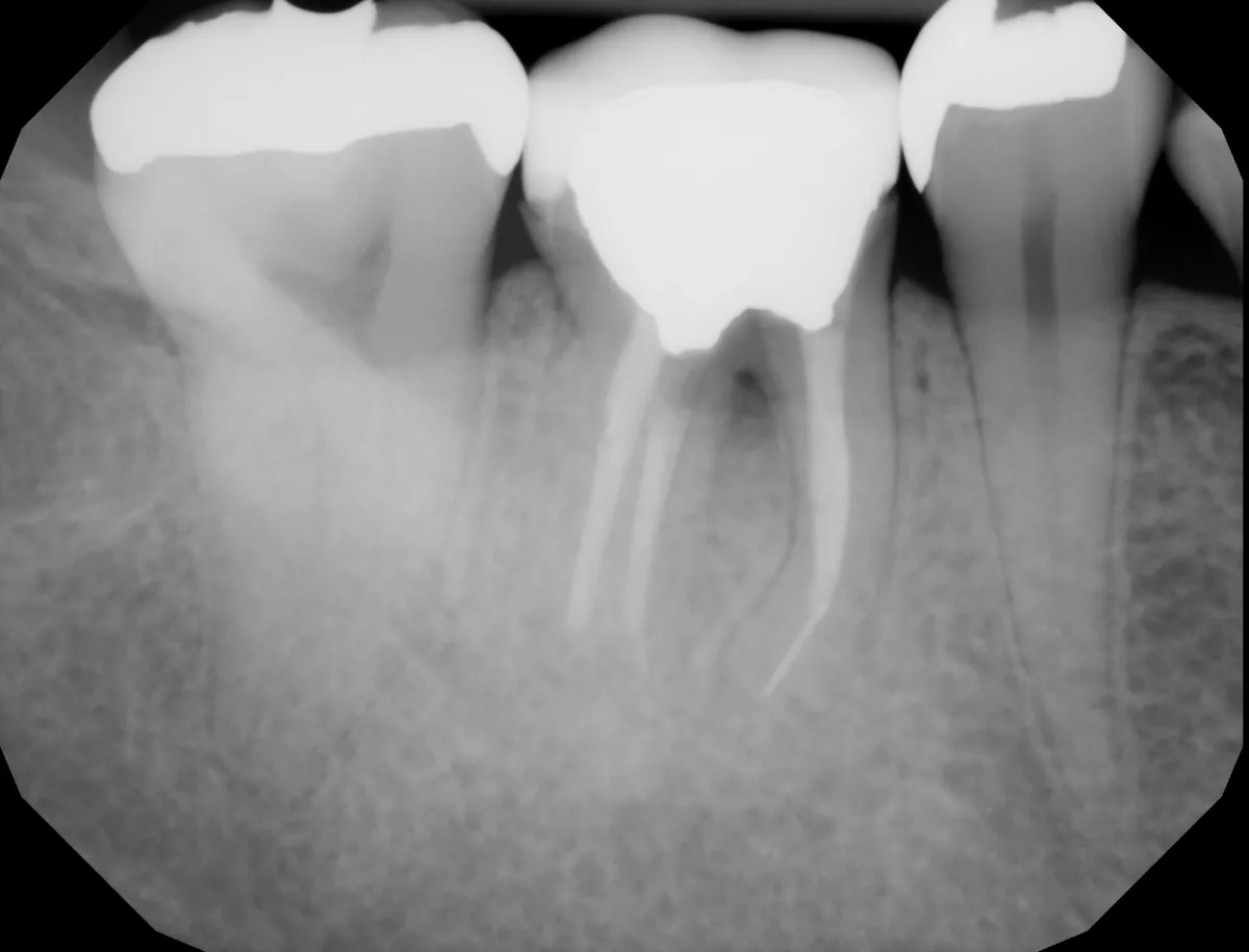 X-ray of a molar that requires extraction