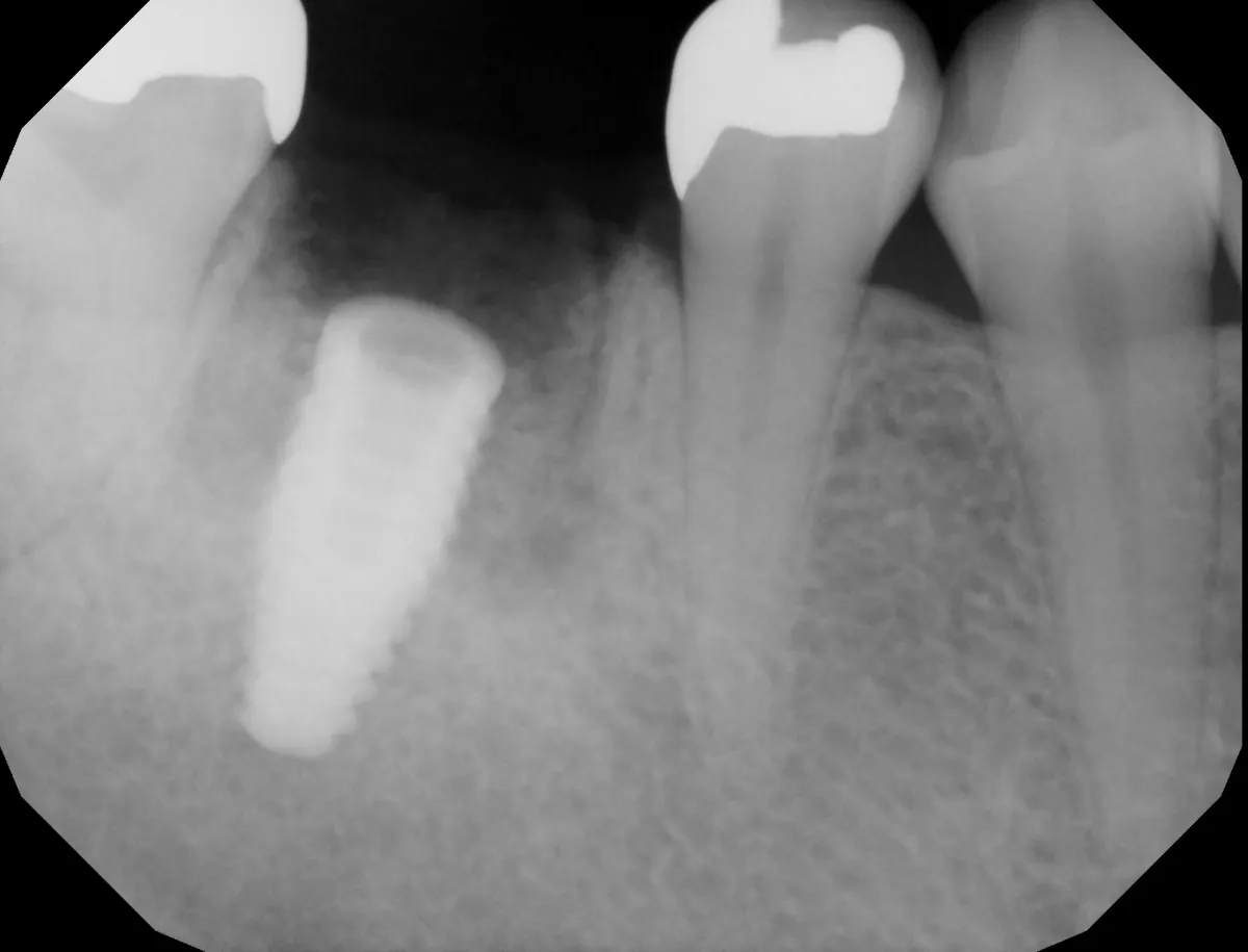 X-ray of immediate implant placement with bone graft