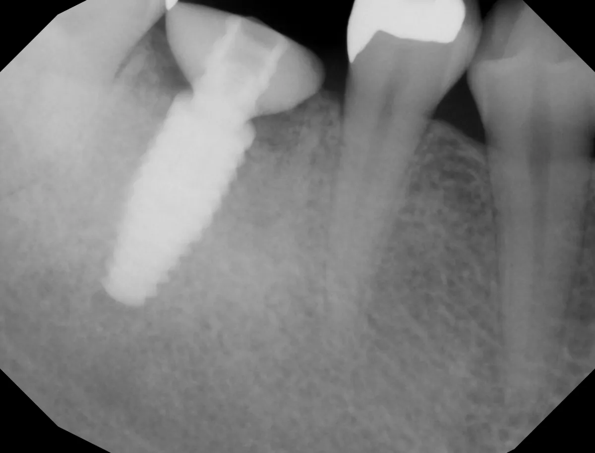 X-ray of the custom healing abutment in place