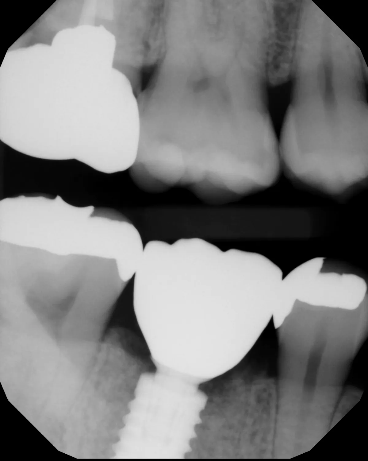 X-ray of the final implant crown in place